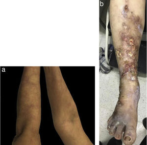 A. Máculas purpúricas reticuladas en cara ventral y dorsal de miembros superiores B. Múltiples úlceras de bordes irregulares, mal definidas, con tejido fibrinoide, secreción serosa escasa y purulenta, tejido de granulación y eritema perilesional.