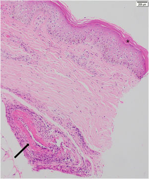 Biopsia de piel (paciente número 3). Hematoxilina y eosina, 10x. Epidermis con ortoqueratosis compacta (*). En la dermis profunda, en cercanía del tejido celular subcutáneo, se observa vasculitis de un vaso de mediano calibre con leucocitoclastia e hiperproliferación de la capa íntima, sin trombos intraluminales (flecha).