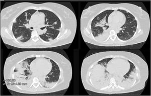 First tomography. Consolidative images were described predominantly in the lung bases, presence of air bronchogram, associated with subpleural nodules.