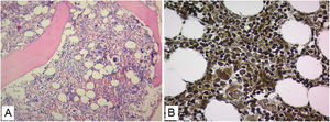 Hypercellular bone marrow biopsy with increased megakaryocytes and increased reticulinic fibers Grade MF-1 (A. H&E stain 20×. B. reticulin stain 40×).
