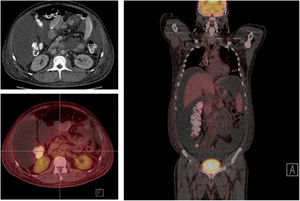 Positron emission tomography with evidence of hypermetabolism in supra and infra diaphragmatic nodes, with abdominal lymph node conglomerate. On the left, location of supraclavicular node.