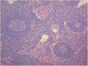 Hyaline-vascular variety Castleman