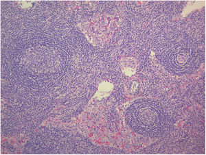 Hyaline-vascular variety Castleman's disease. Lymphoid follicles with concentric expansion of the mantle zone around atrophic germinal centers and interfollicular vascular proliferation (H&E stain 20×).