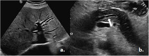 Ecografía de abdomen. a) Dilatación de la vía biliar. b) Dilatación del Wirsung (flecha blanca). Tomado del Servicio de Imagenología del Hospital Metropolitano.
