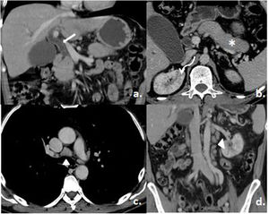 Tomografía contrastada de tórax y abdomen. a) Dilatación y realce del colédoco (flecha blanca). b) Pérdida de sus lobulaciones periféricas del páncreas (asterisco) y defectos múltiples de la perfusión renal (flecha curva). c y d) Adenomegalias mediastinales y retroperitoneales (puntas de flecha). Tomado del Servicio de Imagenología del Hospital Metropolitano.