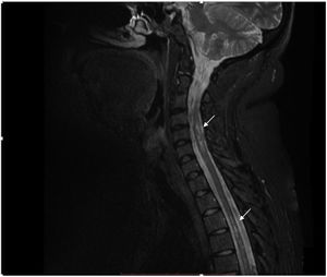 RM secuencia T2 que presenta imágenes focales hiperintensas a nivel del cordón medular de ubicación predominantemente lateral de distribución difusa en columna cervical y dorsal (flechas).