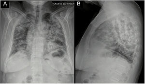 Radiografía de tórax: proyección posteroanterior (A) y lateral (B) con presencia de opacidades alveolares que comprometen 4 cuadrantes.