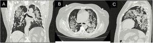 Tomografía de alta resolución de tórax proyección coronal (A), axial (B) y sagital (C). Engrosamiento de las paredes de la vía aérea central y áreas de consolidación de distribución broncéntricas distribuidas en ambos pulmones, algunas asociadas con áreas de vidrio esmerilado.