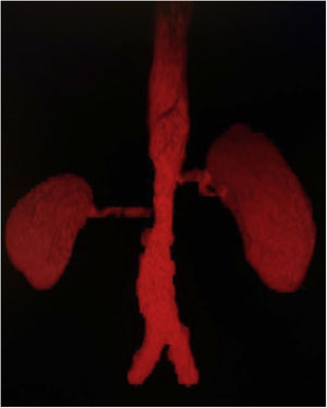 Angiotomografía de aorta abdominal con reconstrucción 3D en la que se observa estenosis de la porción suprarrenal hasta la bifurcación, con estenosis de las arterias renales.