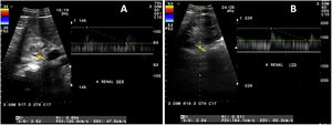 Ultrasonido Doppler de arterias renales. A) Arteria renal derecha: velocidad sistólica máxima de 120cm/s a nivel del ostium y 120cm/s a nivel de hilio, índice de resistencia de 0,60. B) Arteria renal izquierda: velocidad sistólica máxima de 137cm/s a nivel del ostium y 164cm/s a nivel del hilio, índice de resistencia de 0,51.