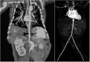 Comparación entre la TC de inicio de diagnóstico (izquierda): se observa aneurisma de aorta descendente y abdominal, estenosis de arteria renal, y la imagen posterior a los primeros seis meses de tratamiento: RM de grandes vasos (derecha) presenta calibres adecuados.