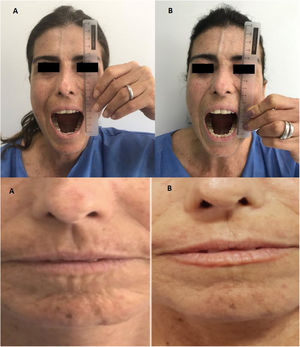 Changed in the Incisor-incisor mouth opening two years after infusion and change in sclerosis and telangiectasis in face. A: Before treatment; B: two years infusion.