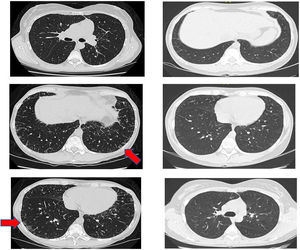 Changed in the high-resolution tomography before treatment, with bibasal reticular abnormalities with minimal ground- glass opacities (red arrows). After therapy no evidence of initial findings, with disappear of ground-glass opacities.