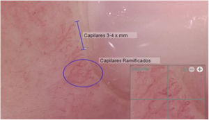 Capillaroscopy findings two years after treatment: Capillary density 3–4×mm, Neoangiogenic capillaries +, Giant capillaries: No, Capillary dilations: No, Hemorrhages: No.