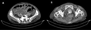 A) Se observa dilatación de intestino delgado con niveles hidroaéreos, sin signo de halo. B) Pared vesical engrosada con cambios inflamatorios.