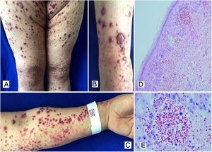 A, B, C) Múltiples maculoplacas purpúricas y ampollas de contenido hemorrágico localizadas en miembros inferiores y superiores, escasas pústulas. D) Biopsia de piel con infiltrado inflamatorio polimorfonuclear perivascular, extravasación de eritrocitos intraepidérmica y escasa necrosis fibrinoide de los vasos dérmicos superficiales. H&E 10X. E) Extravasación de eritrocitos. H&E 40X.