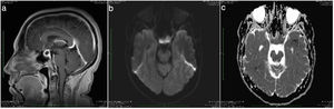 A) Lesión intraselar con extensión supraselar. B) Comportamiento hipovascular posterior a la aplicación de contraste intravenoso. C) El infundíbulo y la glándula hipofisaria se encuentran desplazados posteriormente, ejerciendo efecto compresivo extrínseco sobre la vía optoquiasmática.