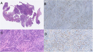 A y C) Coloración de H&E. Hipófisis con infiltrado linfoplasmocitario abundante dentro del estroma colágeno, con focos escleróticos. B y D) Técnica de inmunohistoquímica. Relación incrementada de IgG4:IgG del 60%.