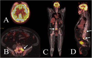 Las imágenes de PET/TC muestran el hipermetabolismo correspondiente al área de realce anormal de las vértebras y el cráneo, con un máximo de 7,5 y 13,9 en L1, L5 y la calota, respectivamente. (A) Tanto el cráneo como el cerebro muestran hipermetabolismo. (B, C, D) Las flechas muestran áreas de hipermetabolismo en las vértebras L1 y L5.