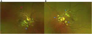 A) Foto a color del ojo derecho: nervio con excavación de 0,1, de bordes definidos, vasos con dilatación de predominio temporal inferior, con rectificación a nivel macular, manchas blancoalgodonosas peripapilares de predominio inferior, hipopigmentación de la retina a nivel peripapilar respetando los vasos, correspondiente a Purtscher-flecken (flecha azul). Hemorragia en mancha hacia la arcada temporal superior (flecha roja). B) Foto a color ojo izquierdo: nervio con excavación de 0,1, de bordes definidos, vasos dilatados de predominio temporal superior, manchas blancoalgodonosas peripapilares, hipopigmentación de la retina a nivel peripapilar, respetando los vasos, correspondiente a Purtscher-flecken (flechas azules).