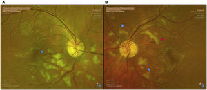 Fotografías a color de ambos ojos de control una semana después de iniciado el tratamiento. A) Ojo derecho: persisten vasos con dilatación de predominio temporal inferior, con rectificación a nivel macular, manchas blancoalgodonosas peripapilares de predominio inferior e hipopigmentación de la retina a nivel peripapilar respetando los vasos, correspondiente a Purtscher-flecken (flecha azul). B) Ojo izquierdo con cambios hemorrágicos leves (flecha roja). Persisten vasos dilatados de predominio temporal superior, manchas blancoalgodonosas peripapilares, hipopigmentación de la retina a nivel peripapilar, respetando los vasos, correspondiente a Purtscher-flecken (flechas azules).