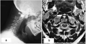 (a) Lateral X-ray of the cervical spine in hyperflexion showing a C1–C2 disatasis. (b) Axial section of MRI showing C1–C2 arthritis, the presence of an edematous pannus, atlantoaxial subluxation.