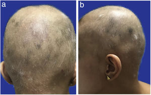 a) Alopecia areata al inicio de tratamiento. Posterior. b) Alopecia areata al inicio de tratamiento. Perfil.