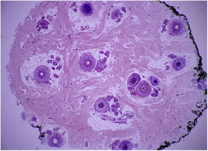 Panorámica: disminución en el conteo de folículos terminales. Infiltrados inflamatorios linfoides alrededor del segmento inferior de los folículos pilosos. 4x.