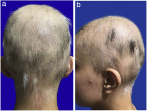 a) Alopecia areata al mes de tratamiento. Posterior. b) Alopecia areata al mes de tratamiento. Perfil.
