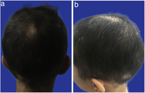a) Alopecia areata a los dos meses de tratamiento. Posterior. b) Alopecia areata a los dos meses de tratamiento. Perfil.