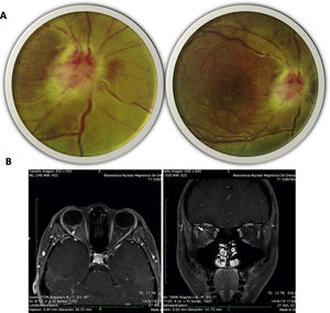 A)Imagen de fondo de ojo derecho: disco óptico derecho de bordes mal definidos, edematizado, características intumescentes, microhemorragias epipapilares en llama, excavación de 0; se evidencia borramiento de bordes del disco, zonas de periflebitis que afectan el polo posterior y edema retiniano peripapilar con algunos infiltrados amarillentos en polo posterior. B)Resonancia magnética de órbitas, secuencia T1 con gadolinio en cortes axial (derecha) coronal (izquierda); se evidencia realce del nervio óptico y de la vaina óptica con el medio de contraste (flechas).