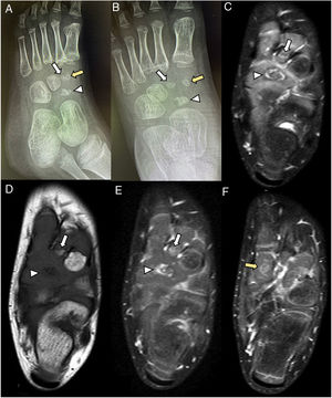 Radiografías y resonancia magnética sin y con contraste intravenoso de pie Navicular (cabeza de flecha), cuña medial (flecha amarilla), cuña intermedia (flecha blanca). A) Radiografía lateral oblicua y B) anteroposterior de pie donde se observa disminución de tamaño, esclerosis e irregularidad de los centros de osificación de la cuña medial, de la intermedia y del navicular, con colapso parcial de este último. C) Secuencia axial potenciada en T2 con supresión grasa que confirma y detalla los hallazgos descritos en radiografía, se evidencia un colapso más marcado del aspecto lateral del navicular, con ribete hiperintenso en su periferia y en la cuña intermedia. D) Secuencia axial potenciada en T1. Se observa una marcada disminución de la intensidad de señal del navicular y discreta de la cuña intermedia. E) y F) Secuencias potenciadas en T1 con supresión grasa tras la administración de contraste iv. Se evidencia un intenso realce en la periferia del navicular, en la cuña medial y en la intermedia, en relación con hiperemia reactiva.