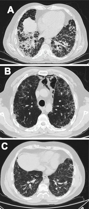 (A) Non-specific interstitial pneumonia pattern. (B) Pneumomediastinum. (C) Follow-up after one-year.