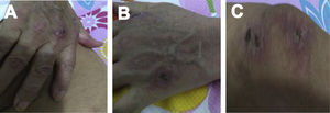 Cutaneous ulcer in metacarpophalangeal joints in the right (A) and left (B) hands, also in the knee (C).