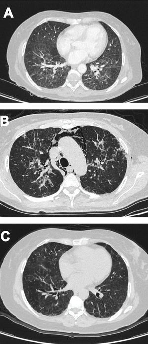 (A) Non-specific interstitial pneumonia pattern. (B) Pneumomediastinum. (C) Follow-up after one-year.