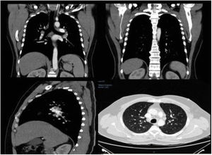 Tomografía axial computarizada de tórax que muestra adenopatías paratraqueales, mediastinales e hiliares en ambos campos pulmonares. Micronódulos en lóbulos e inferiores de ambos pulmones.