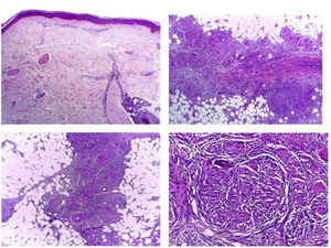 Biopsia de piel y tejido celular subcutáneo en la que se observan múltiples granulomas de tipo sarcoidal a nivel de dermis profunda, componente septal y parte del lobulillar del panículo adiposo. No se observa necrosis ni vasculitis.