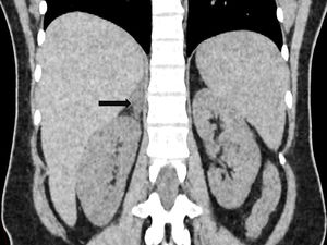 Tomografía abdominal contrastada, se visualiza una hipodensidad difusa de la glándula adrenal derecha al compararse con la izquierda. Estos hallazgos son consistentes con un infarto adrenal no hemorrágico de la glándula adrenal derecha.