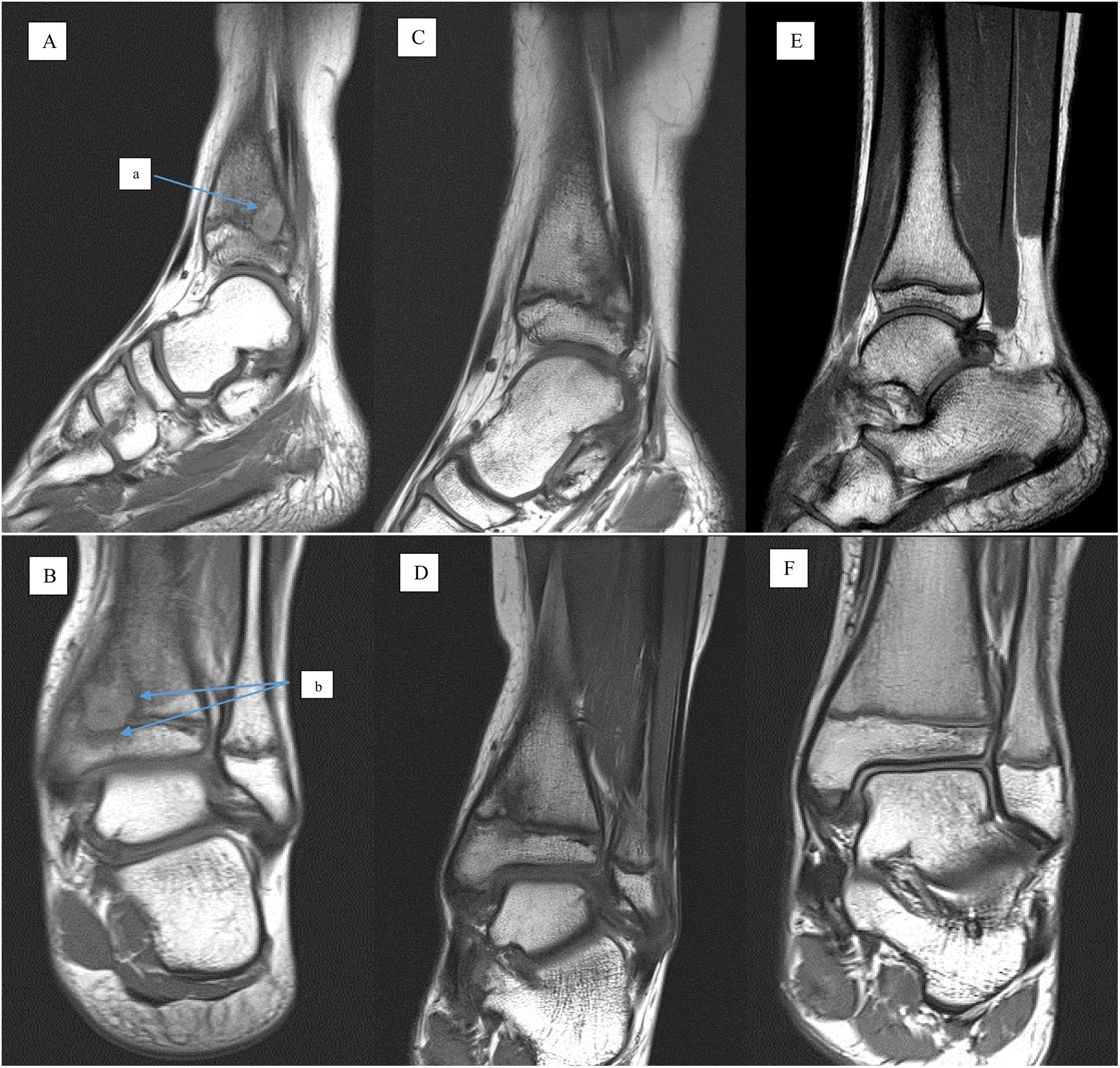 Tibia Abscess Exclusively oral antibiotic therapy for Brodie's abscess in a pediatric ...