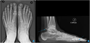 Radiografía simple en carga de pie, con proyecciones anteroposterior (A) y lateral del pie derecho (B). Se visualizan varias imágenes de alta densidad y morfología redondeada sugerentes de calcificaciones en la región de los tendones del compartimento posterior, así como en la fascia plantar del hallux (flechas).