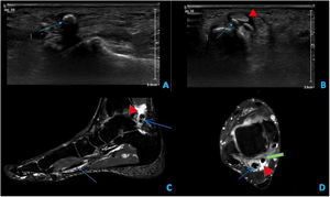 A,B)Imágenes de ecografía de pie derecho en las que se visualiza líquido anecoico en la vaina del tendón del flexor propio del dedo gordo (flexor hallucis longus) en relación con tenosinovitis (cabeza de flecha roja), así como focos hiperecogénicos en el interior de la vaina que representan los focos condrales calcificados (flecha azul). C,D)Imágenes de RM de pie derecho, secuencia T2 con supresión grasa sagital (C) y axial localizada en tobillo (D). Se observa líquido en la vaina del tendón flexor propio del primer dedo (cabeza de flecha roja: líquido; flecha verde: tendón) con numerosas calcificaciones en su interior, tanto en su inserción como a su paso por el tobillo, visualizadas como focos hipointensos y redondeados (flechas azules).