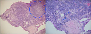 Biopsia de conjuntiva bulbar superior de ambos ojos. Se evidencia formación de granuloma (izquierda) y células gigantes multinucleadas e infiltrado inflamatorio crónico (derecha). Histopatología tomada por los autores.