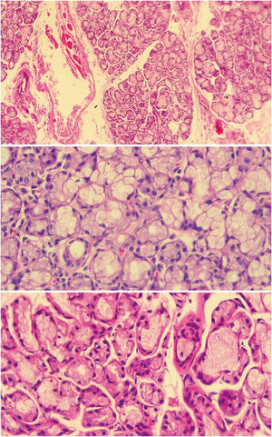 Histología de glándula salival menor normal. En los tres cortes se observa glándula salival de histología normal de un paciente incluido en el estudio, en los que se ven acinos mucinosos con células mioepiteliales y ductos. La imagen superior en aumento de 10× y las imágenes inferiores en aumento de 40×. Fuente: elaboración propia.