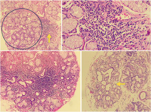 Histología de Glándula Salival menor alterada. En la imagen superior izquierda se observa una biopsia de glándula salival de un paciente incluido en el estudio, en un corte de 10× con un agregado de células linfoides (flecha amarilla) adyacente a glándula salival de apariencia normal (circulo azul). En la imagen superior derecha se observa el mismo agregado en un aumento de 40×. Este agregado se puede contar como un foco. En la imagen inferior izquierda se observa un agregado denso de linfocitos en un fondo de glándula salival de uno de los pacientes analizados en el estudio, con atrofia y dilatación ductal. En la imagen inferior de la derecha podemos ver una biopsia de glándula salival con ectasia ductal (flecha) y atrofia. Fuente: elaboración propia.