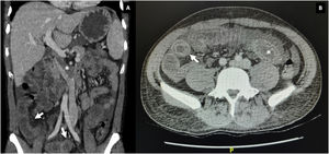 Tomografía contrastada de abdomen. A) Corte coronal, trombosis de la vena cava inferior (asterisco) y edema de la pared del íleon con signo de la diana (flechas blancas). B) Corte axial, signo de la diana (flecha blanca) dilatación intestinal (asterisco).
