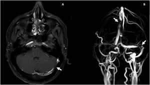 Resonancia magnética contrastada cerebral. A) T1 posgadolinio, trombosis venosa parcialmente recanalizada en la confluencia del seno trasverso y sigmoideo izquierdo (flecha blanca). B) Venorresonancia, defecto de flujo central en la unión del seno transverso y sigmoideo izquierdo y en el aspecto posterior del seno sagital superior (flechas blancas).