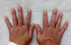 Pápulas de Gottron. Pápulas y máculas eritematosas sobre las articulaciones metacarpofalángicas que se extienden por la cara dorsal de las falanges de ambas manos, compatibles con pápulas de Gottron. Se evidencia además eritema periungular en ambas manos.