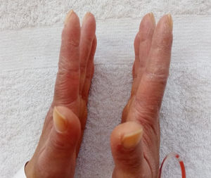 Manos de mecánico. Se evidencian hiperqueratosis y fisuras cutáneas en la cara radial del primer y el segundo dedo de ambas manos. Imagen compatible con el signo de «manos de mecánico».