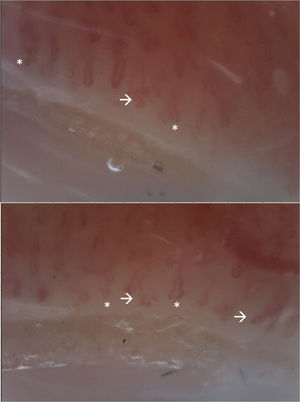 Video-capilaroscopia. Lecho vascular con edema marcado de papila, tortuosidades lineales y en su mismo eje (*), sin microhemorragias ni megacapilares. Se evidencian ramificaciones (flecha). Patrón anormal, correspondiente a patrón no escleroderma. La presencia de múltiples ramificaciones sugiere la presencia de dermatomiositis.