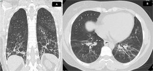 Tomografía de tórax con hallazgos de EPI. Tomografía de tórax en corte coronal (A) y axial (B). Se evidencia vidrio esmerilado de distribución peribroncovascular, con mayor afectación de segmentos posteriores y lóbulos inferiores, donde se identifican reticulación, bandas parenquimatosas, engrosamiento de paredes bronquiales y bronquiectasias de tracción con pérdida de volumen asociada, debido a retracción de cisuras. Hallazgos compatibles con patrón de NINE fibrótica. Extensión calculada del 30%.